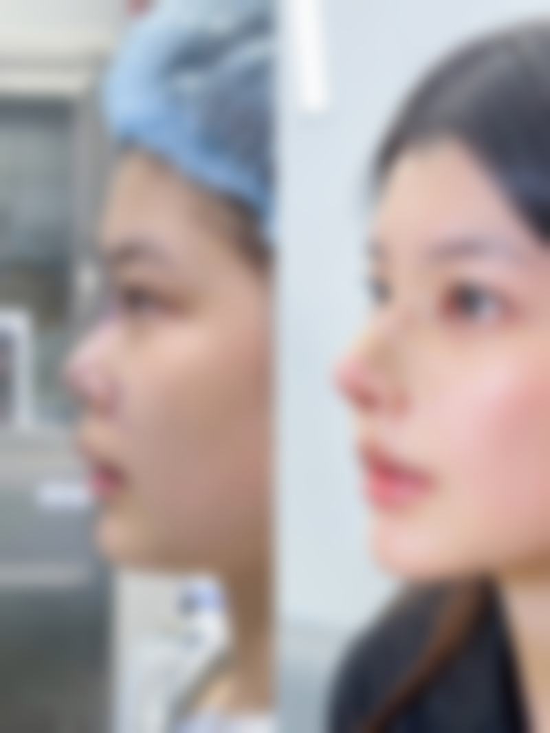 长期被黑眼袋困扰,护理与外界刺激有啥作用?