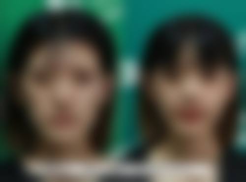 溶脂做眼袋,操作有啥要求?