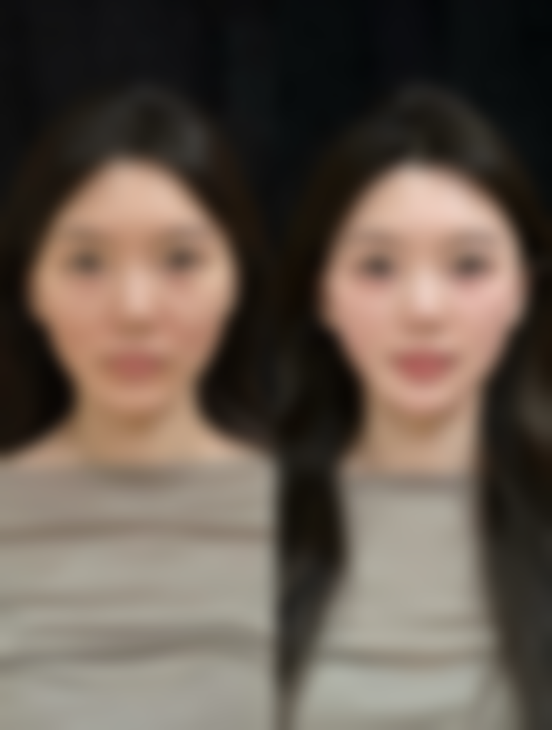 溶脂做眼袋,术后护理难吗?