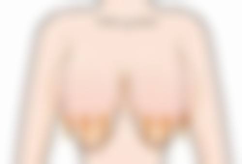 隆胸假体破裂会怎样?检查方式特别重要