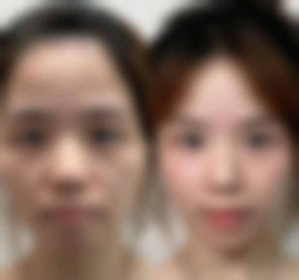 打了瘦脸针多久会反弹？普遍4 - 6个月，连续注射3 - 4次可延长至7 - 8个月 