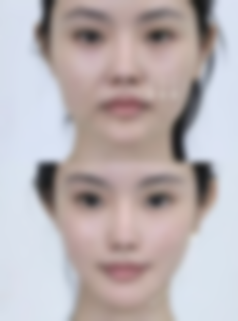 隆胸假体破裂会怎样?潜在后果要了解