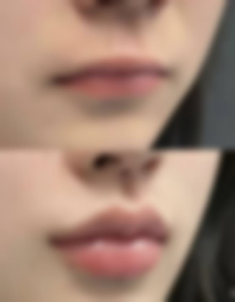 隆胸后究竟能否给小孩喂奶？影响顺利哺乳的因素揭秘