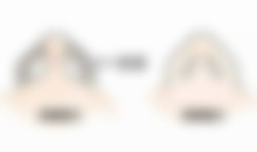 硅胶隆鼻危害知多少之假体移位/异常