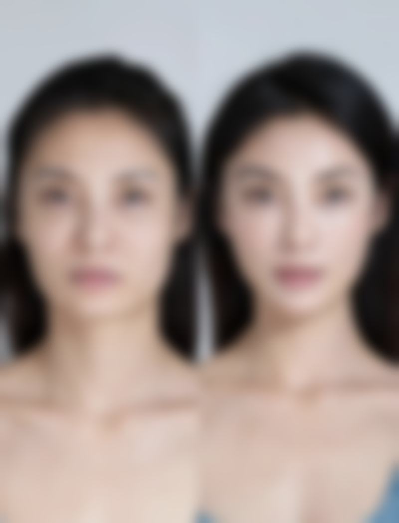 硅胶隆鼻危害知多少之包膜挛缩与排异反应