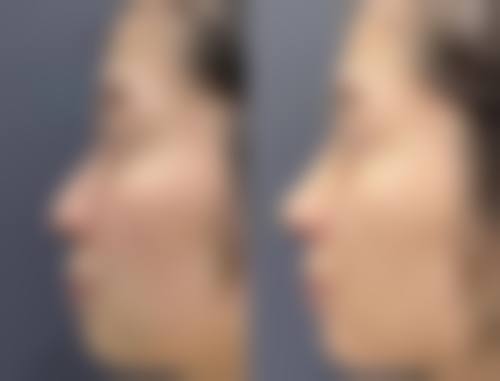 配套改善方案：结合瘦脸针，成效更上一层楼