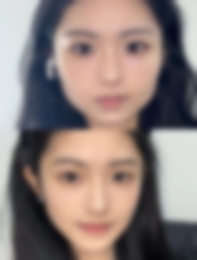 隆鼻假体的术后护理:保护健康