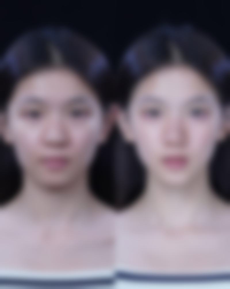 做完眼袋出现疤痕增生能下去吗？多数可消退，护理与治疗助普通人群3 - 6个月恢复 