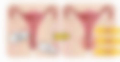 怎样拥有持久清晰双眼皮？埋线手术显神通