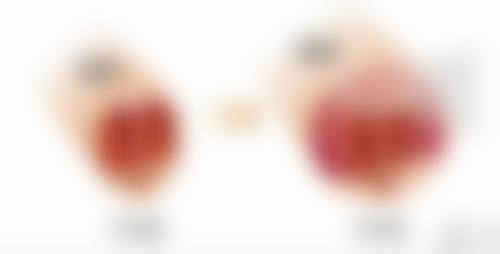 虞美人裸妆仙子隆鼻：硬分子透明质酸的塑形魅力