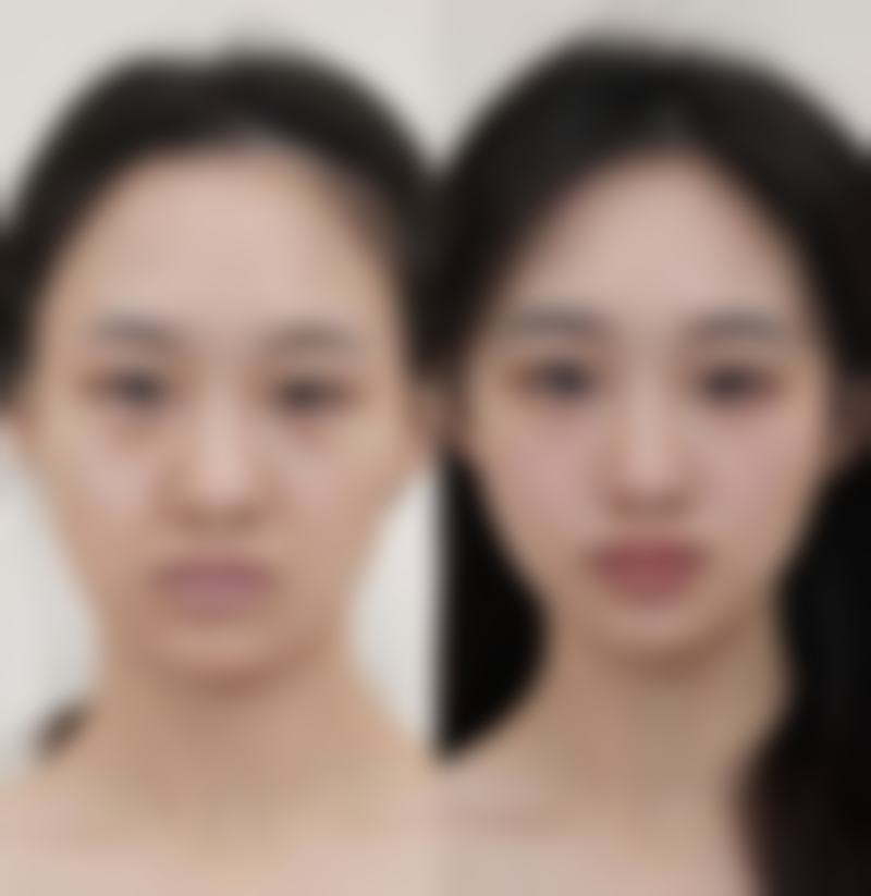 瘢痕体质做埋线双眼皮的风险和应对办法