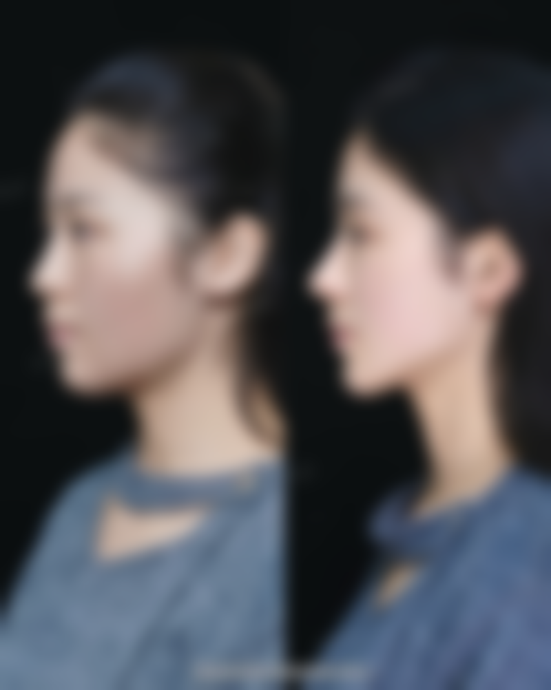 甘油真能去除眼袋吗?科学去眼袋的方式
