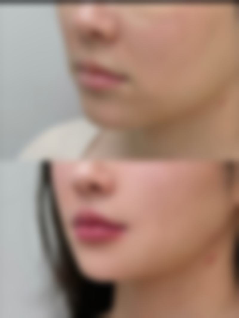 自体隆鼻软骨后遗症大揭秘:外形不佳情况