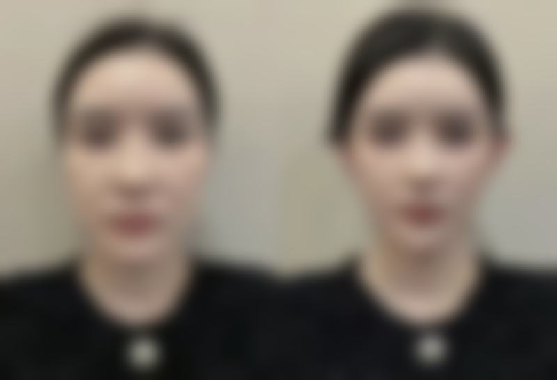 自体隆鼻软骨后遗症大揭秘：术后感染、外形不佳等问题及降低风险措施详解 