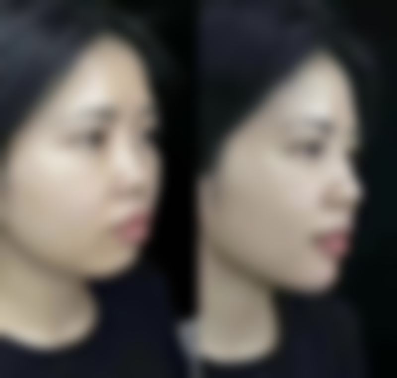 揭秘小腿抽脂后遗症:中度问题咋处理,风险咋降低?