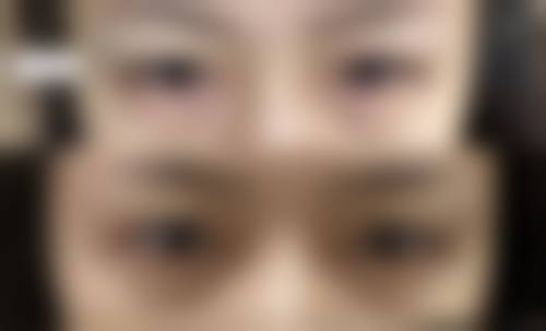 微创双眼皮,为上睑薄且年轻群体打造美丽双眸