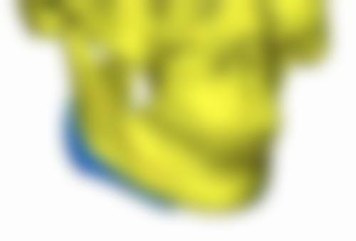 哪些因素会影响三点定位双眼皮的持久性?