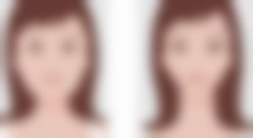 做个双眼皮究竟要多久?联合附加手术时长揭秘