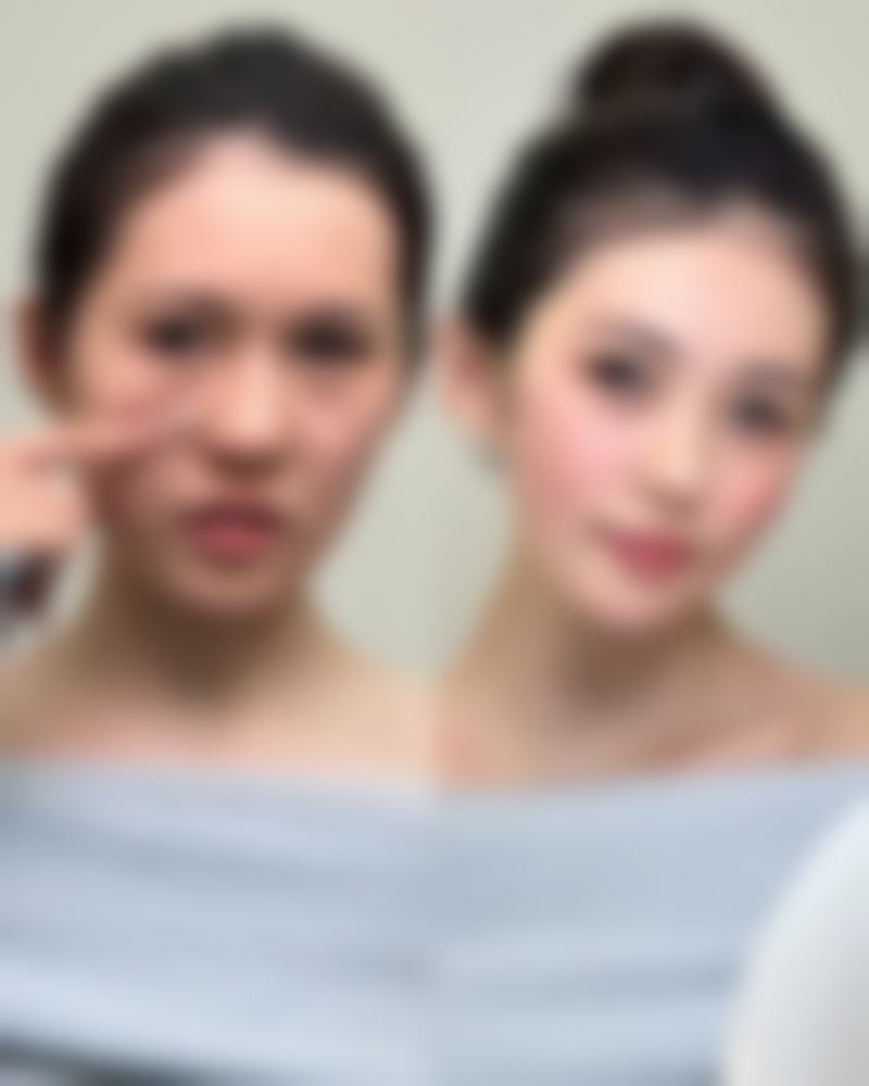 痘痘后遗症增生疤痕怎么改善?激光治疗显神通
