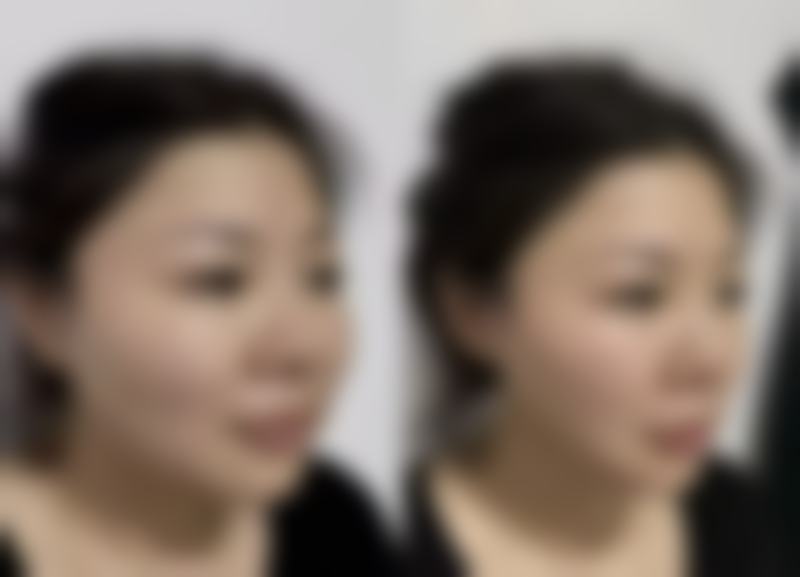三点定位双眼皮一般能维持多久?