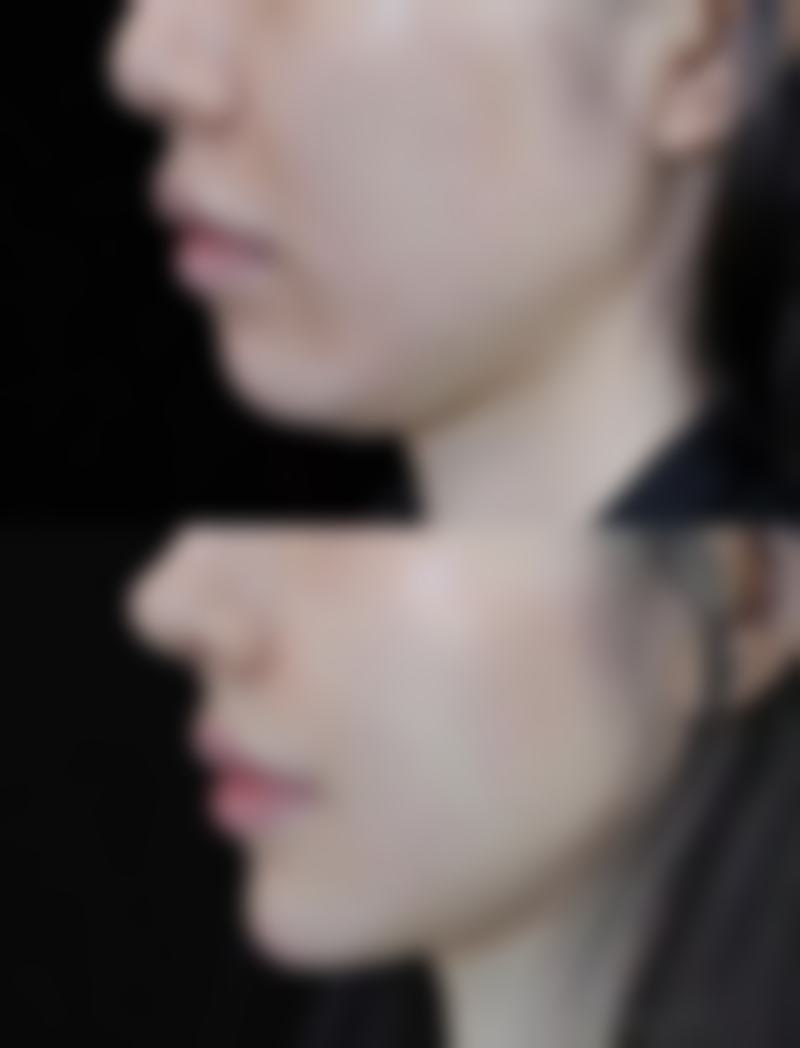 如何巧妙修复缝针疤痕?可选的修复方案大揭秘