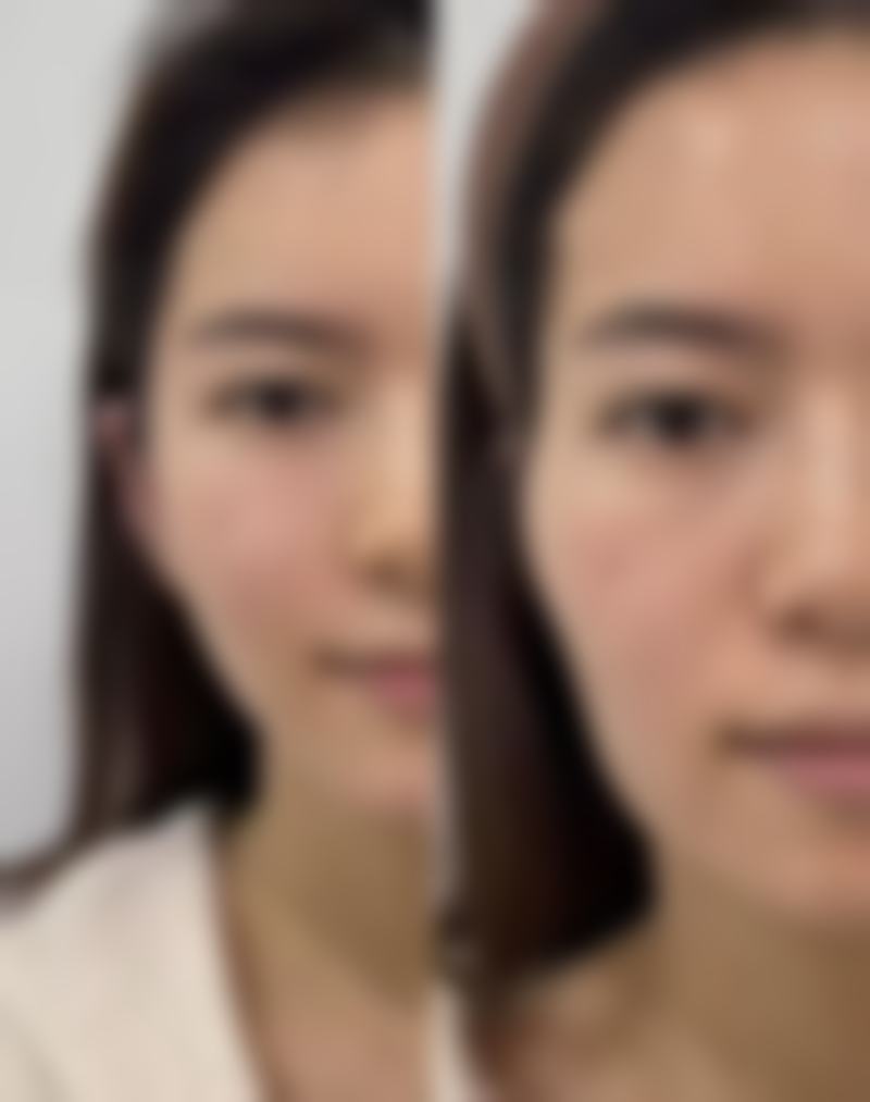想摆脱疤痕疙瘩？手术切除显神通