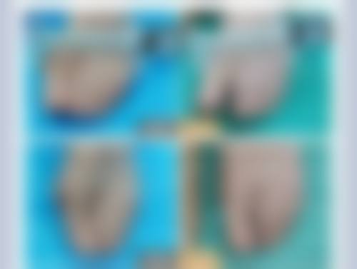 做双眼皮后抹啥能消肿？抗生素、促愈合等药膏助你快速消肿、防疤促愈 