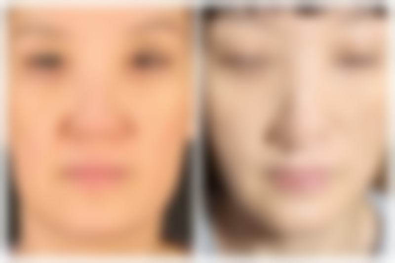 全切双眼皮术后护理要点不能忘