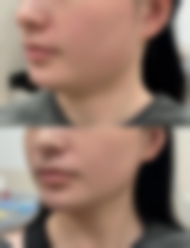 做双眼皮后消肿:消肿乳膏的使用方法