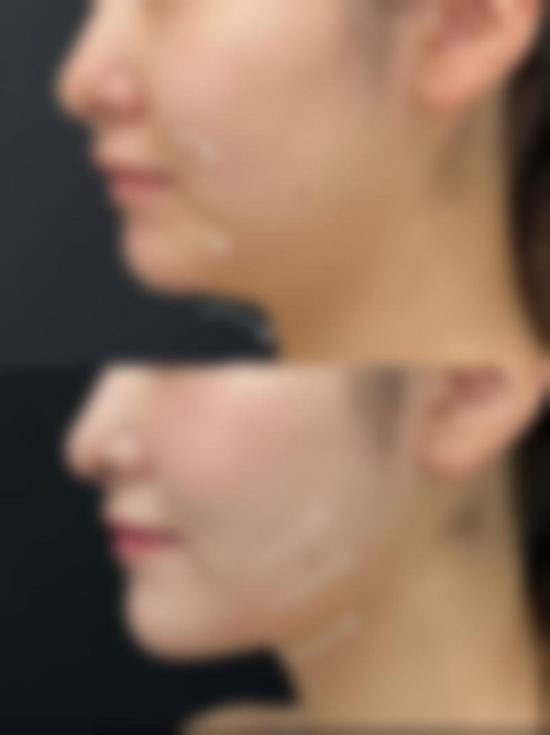 身体抽脂后会反弹吗?认识反弹的核心诱因