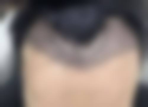瘦脸针引发的肌肉功能异常危害