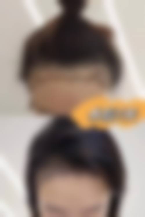 五、厦门碧莲盛无痕植发整形实例