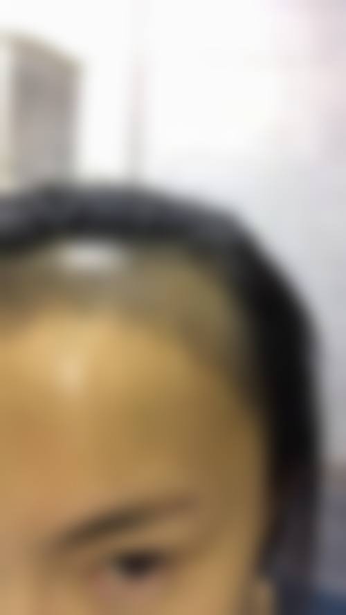 八、厦门碧莲盛无痕植发整形真实的顾客评价如下: