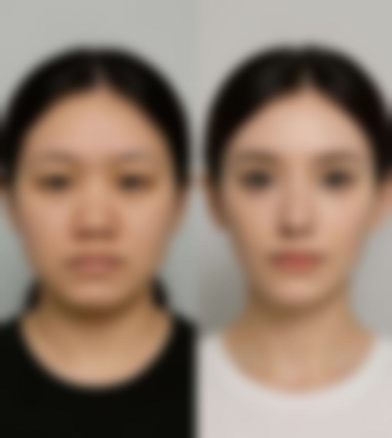 揭秘割窄双眼皮加宽的成功实例优势