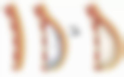自体耳软骨隆鼻修复后的优势:自然美鼻,魅力无限