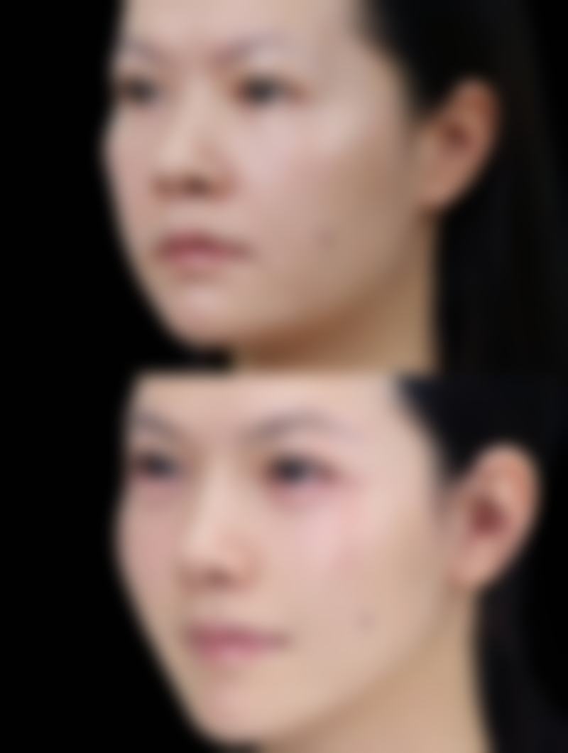 国字脸打瘦脸针:成效有限或无效场景分析