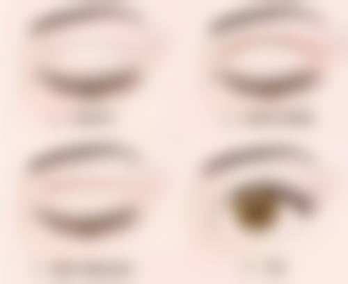 割完双眼皮拆线后,有轻微发红/紧绷感时何时能洗脸?
