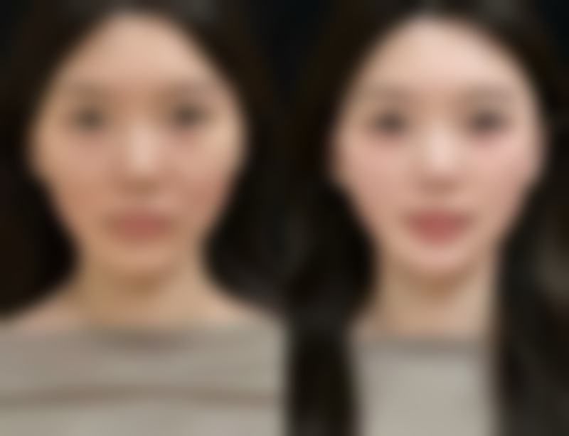 肋软骨隆鼻自然逼真成效真有那么好吗?